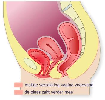 voorwandverzakking stadium 2