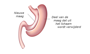 ZGT - OBC - gastric sleeve.png