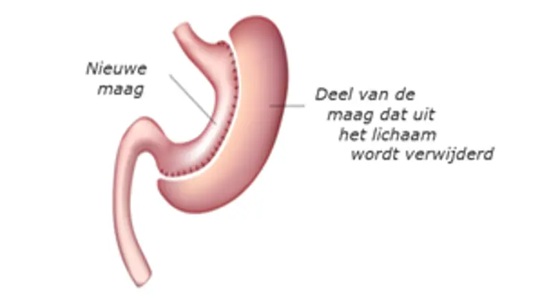 ZGT - OBC - gastric sleeve.png