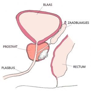 Prostaatkanker stadium T3
