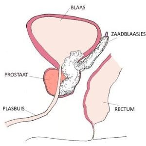 Prostaatkanker stadium T4