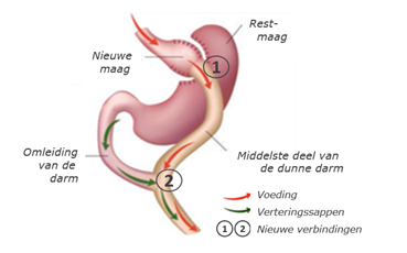 ZGT - OBC - gastric bypass.png