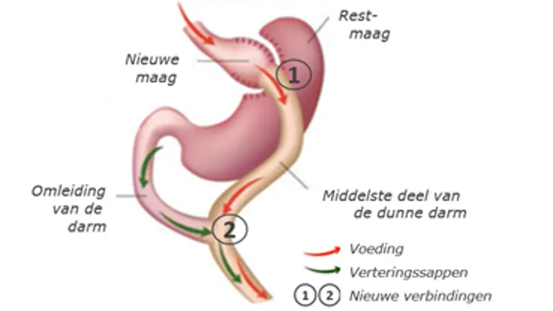 ZGT - OBC - gastric bypass.png