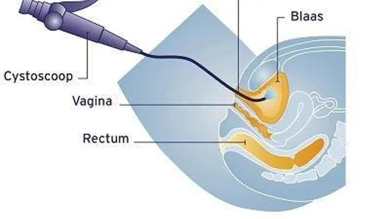 bekkenbodemklachten - Onderzoeken door de uroloog_cystoscopie.jpg