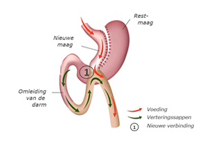 ZGT - OBC - mini gastric bypass.png