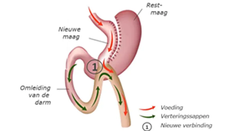 ZGT - OBC - mini gastric bypass.png